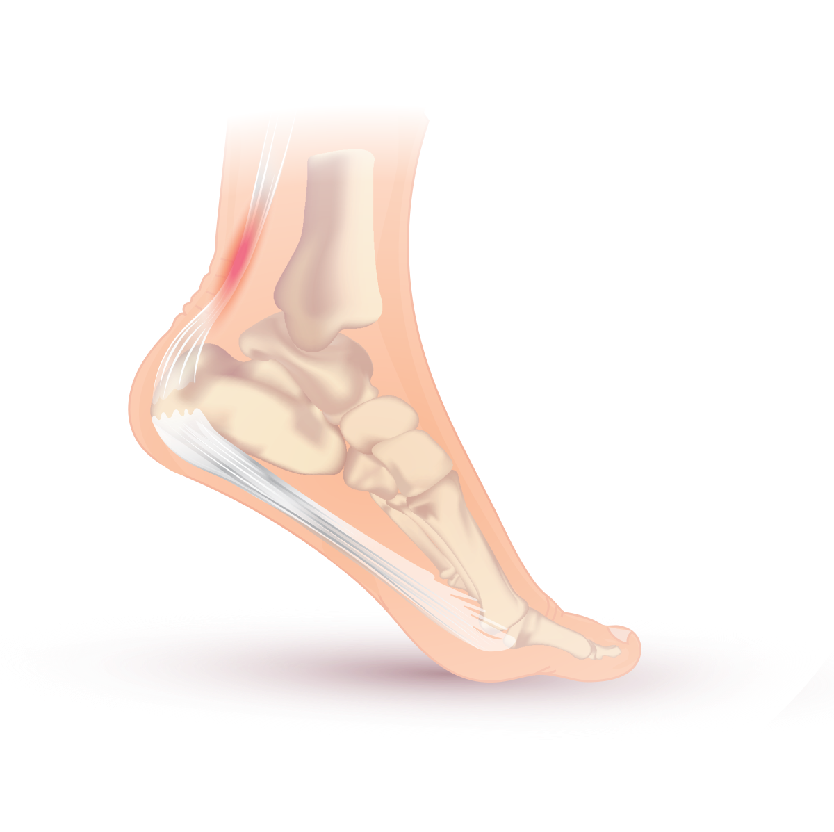 Insertional Achilles Tendonitis Treatment and Symptoms – Medical Wave