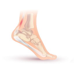 Achilles tendonitis