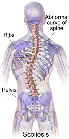 Blausen 0785 Scoliosis 01.png