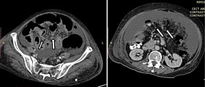 Fig. 10. A. Starry mesentery pattern (arrows) of peritoneal carcinomatosis in a 65 year old female case of carcinoma pancreas. B. Small bowel mesentery infiltrated with multiple micro and macronodules (arrows) in a 68 year old female case of peritoneal carcinomatosis with unknown primary.[1]