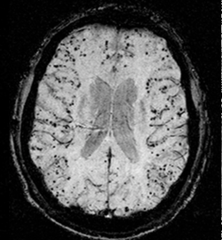 تصوير بالرنين المغناطيسي للاعتلال الوعائي النشواني الدماغي (CAA).