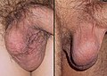 Different views of testicles of a 42 years old adult.jpg