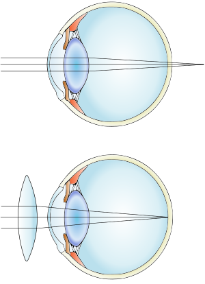 hypermetropia lens