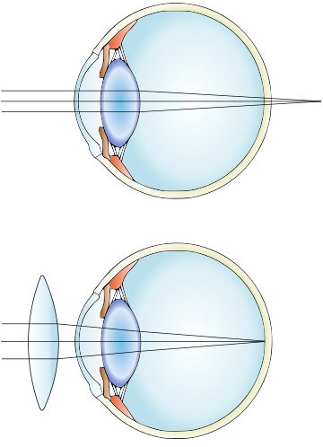 Farsightedness