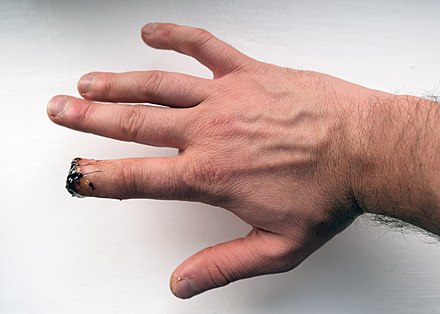 Partial amputation of index finger.