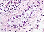 Thumbnail for Germ cell neoplasia in situ