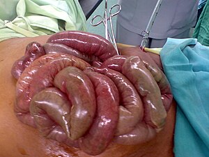 Ischemic bowel.JPG