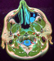 Mucous retention cyst in maxillary sinus indicated by the asymmetrical blue lump to the right of the nose MRI 114124 rgbca.png