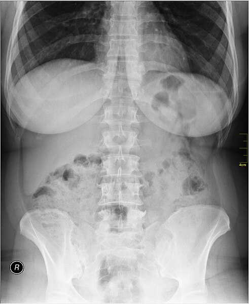 File:Medical X-Ray imaging OXA06 nevit.jpg