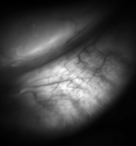 Meibomian glands in the lower eyelid imaged under amber light to show vasculature support and the gland structure.