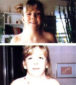 Neck of girl with Turner Syndrome (before and after).jpg