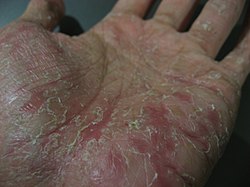 Advanced stage of palmar dyshidrosis on the palm showing cracked and peeling skin