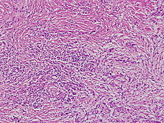 Poorly differentiated adenocarcinoma(por2).jpg