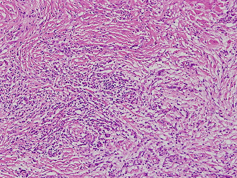 File:Poorly differentiated adenocarcinoma(por2).jpg