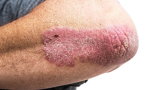 Psoriasis on elbow