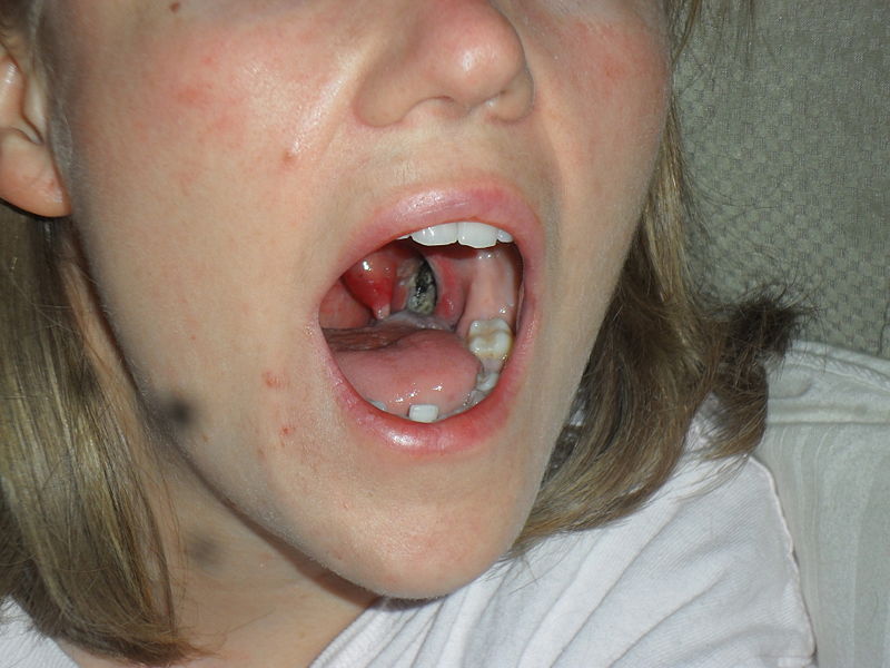 File:Tonsillectomy left fosa.jpg