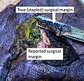 True and reported surgical margin