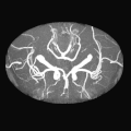 Poligono di Willis, immagine di risonanza magnetica, sequenze angiografiche