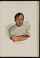 38 year old man suffering from scurvy. Baumgartner, 1929 Wellcome L0074309.jpg
