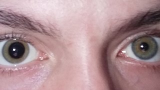 Anisocoria condition characterized by an unequal size of the eyes pupils