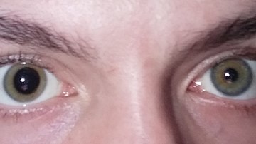 Anisocoria0