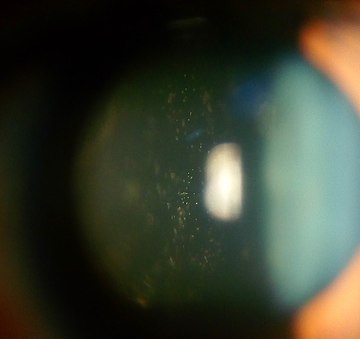 Intermediate uveitis