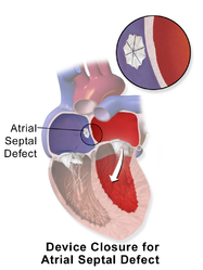 Correction of an atrial septal defect using a percutaneous device.