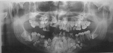 Panoramic view of the jaws showing multiple unerupted supernumerary teeth mimicking premolar, missing gonial angles and underdeveloped maxillary sinuses in cleidocranial dysplasia