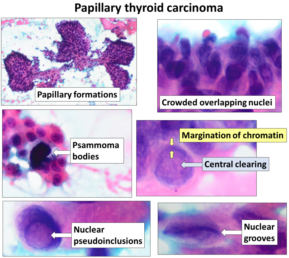 Papillary Thyroid Cancer-avatar