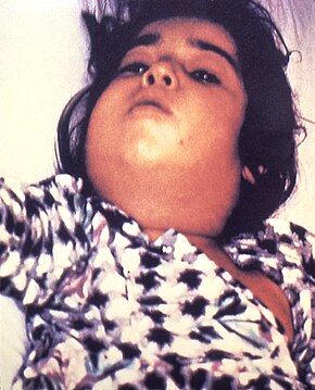 Diphtheria can cause a swollen neck, sometimes referred to as a bull neck. Diphtheria bull neck.5325 lores.jpg