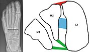 Miniatura para Ligamento de Lisfranc