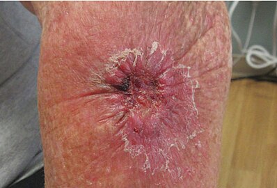 Malignant Melanoma left forearm post excision with purse string closure (Original Post: Shared in Melanoma)