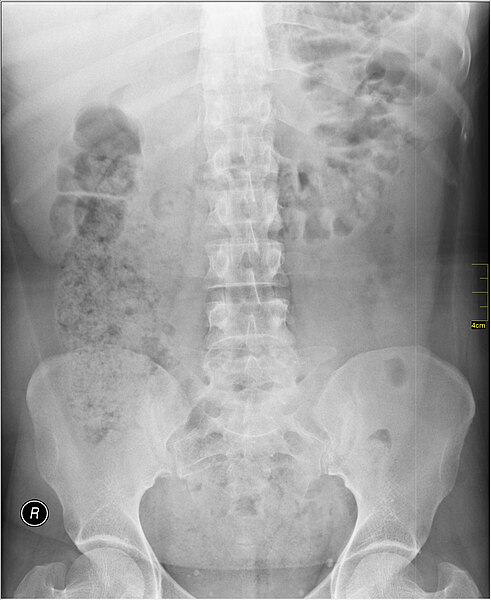 File:Medical X-Ray imaging TBR07 nevit.jpg