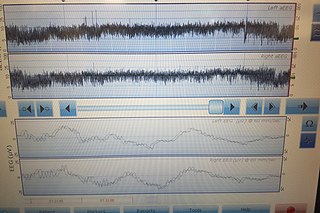 <span class="mw-page-title-main">Amplitude integrated electroencephalography</span> Technique for monitoring brain function in intensive care settings