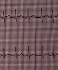 Vignette pour Fibrillation atriale