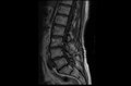 MRI lumbar spine post-hemilaminectomy (sagittal T1 FSE)