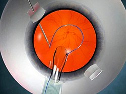 Fig 3: Animation showing glued IOL surgery. Note the flaps made on the white portion of the eye (sclera). The IOL is injected inside the eye and one end (haptic) is grasped with the glued IOL forceps Animation showing glued IOL surgery.jpg