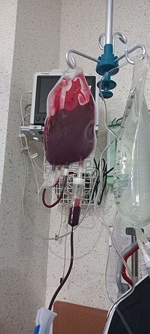 As the person receives their blood transfusion, the bag slowly empties, leaving behind blood that has clotted before it could be administered. Blood unit during transfusion.jpg