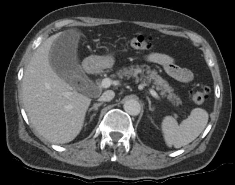 File:CT of cholecystitis.jpg