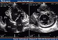 Cardiovasc Ultrasound LVNC 1.jpg