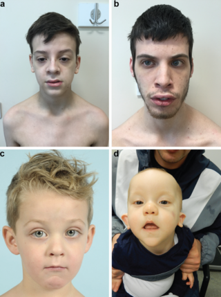 <span class="mw-page-title-main">Beck–Fahrner syndrome</span> Rare genetic disorder