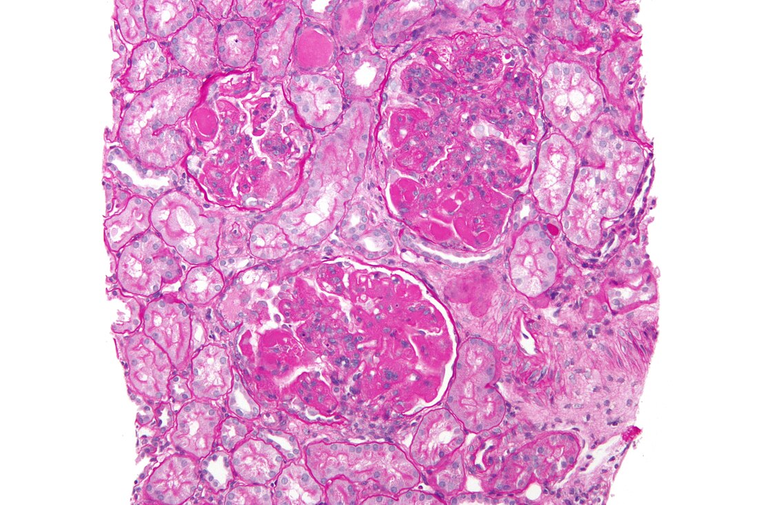 Lupus nephritis