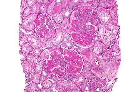 صورة مجهرية of diffuse proliferative lupus nephritis showing increased mesangial matrix and mesangial hypercellularity. خزعة كلوية. PAS stain.