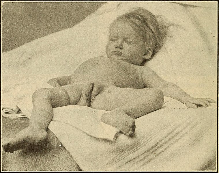 File:Diseases of infancy and childhood (1914) (14791925393).jpg