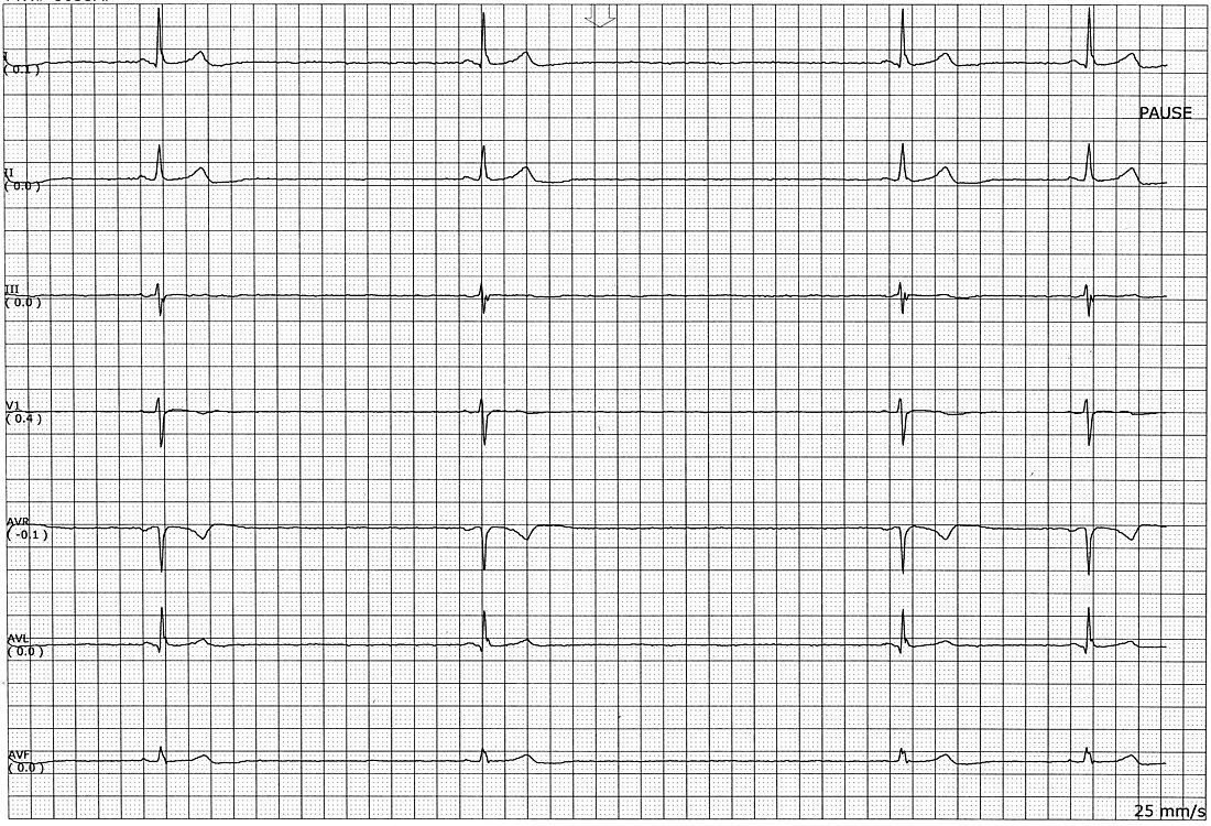 Sinus node dysfunction