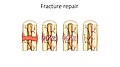 Fracture repair