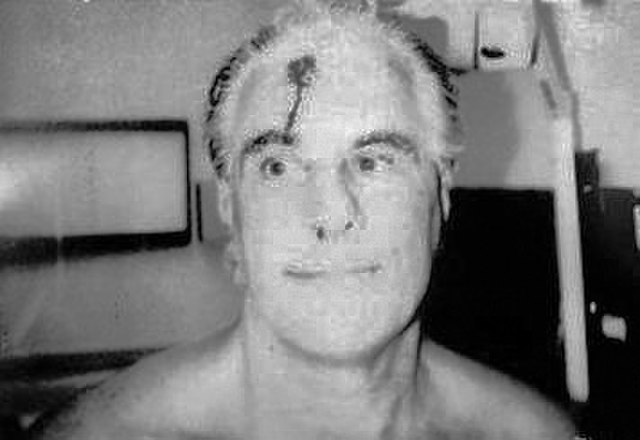 Photo of John Gotti after he was beaten by a fellow inmate in July 1996
