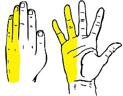 تصوير كرتوني للتوزيع الحسي الزندي التقليدي، ويشمل الإصبع الخامسة ونصف الإصبع الرابعة. لاحظ أن هذا الرسم البياني لا يصور عضلات اليد المصابة بالاعتلال العصبي الزندي.