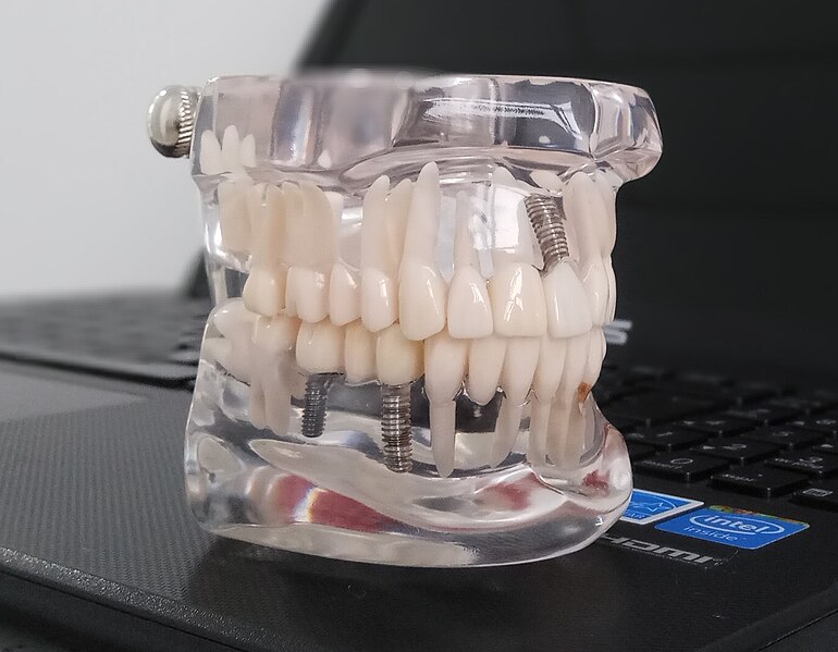 File:Implantes Dentales en Coruña.jpg