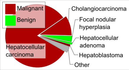 Liver tumour types by relative incidence in adults in the United States, with hepatoblastoma at right